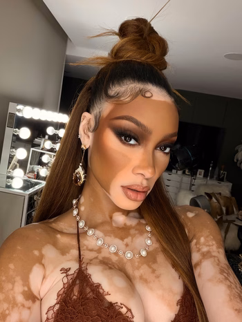 Winnie Harlow - Photo 4